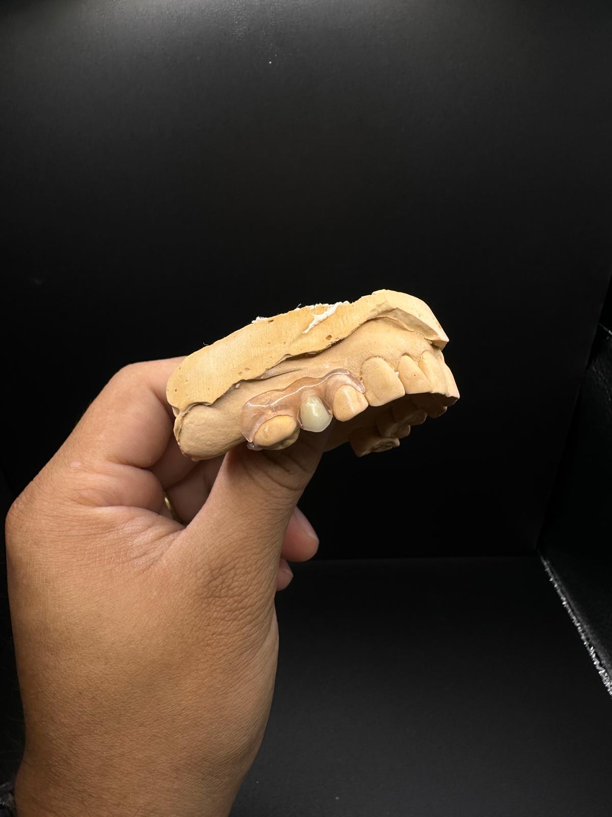 Single crown fitted on a stone model