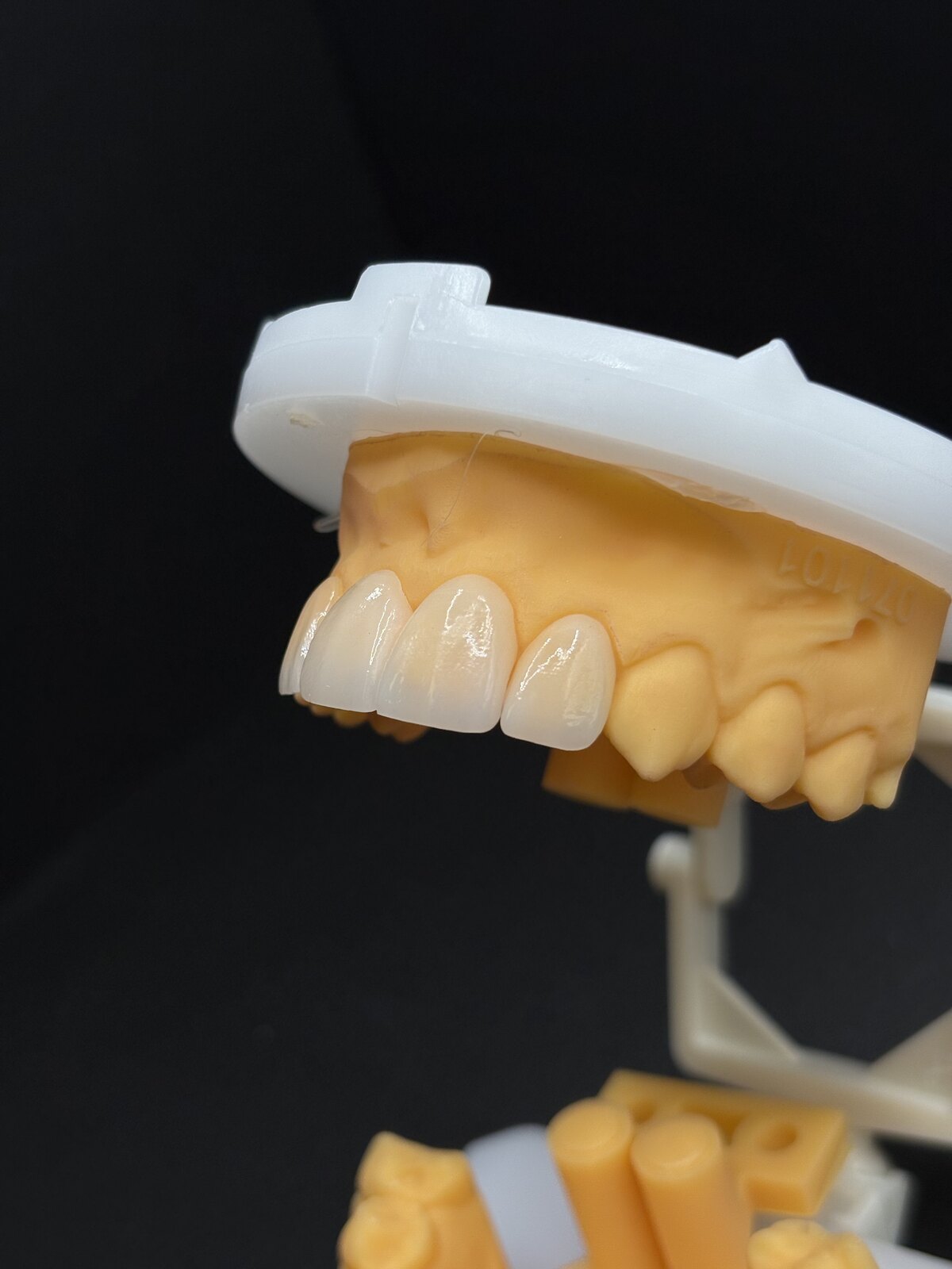Anterior crowns finished on a dental model