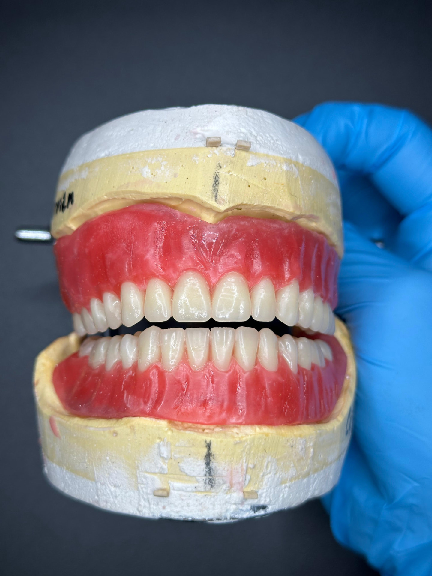 Upper and lower full dentures with teeth set in wax, crafted at Alliance Dental Lab