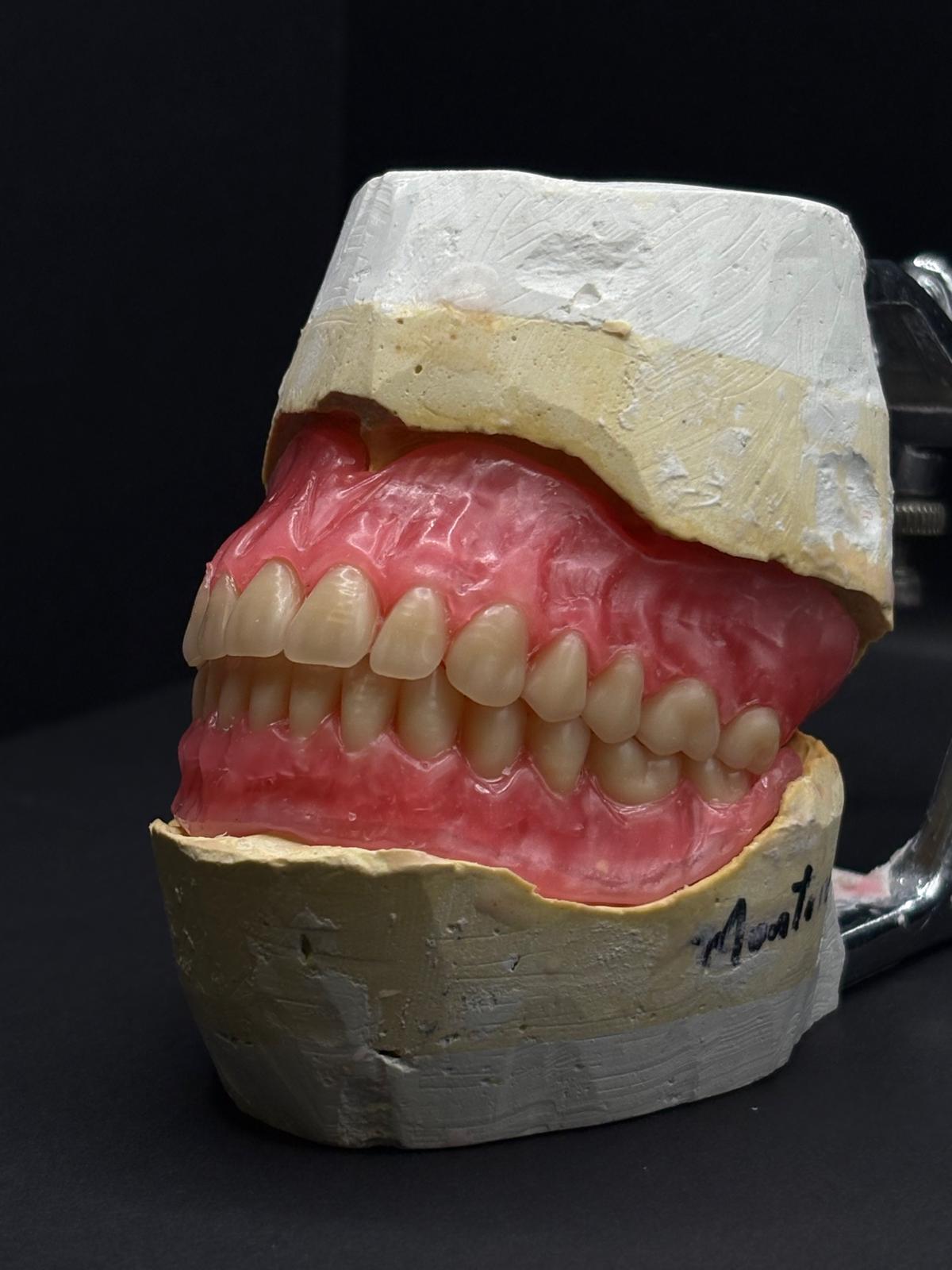 Esthetic veneers placed on an upper study model