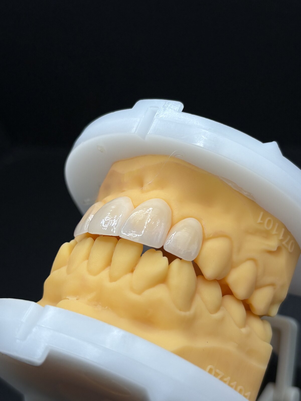 Anterior veneers seated on a dental study model