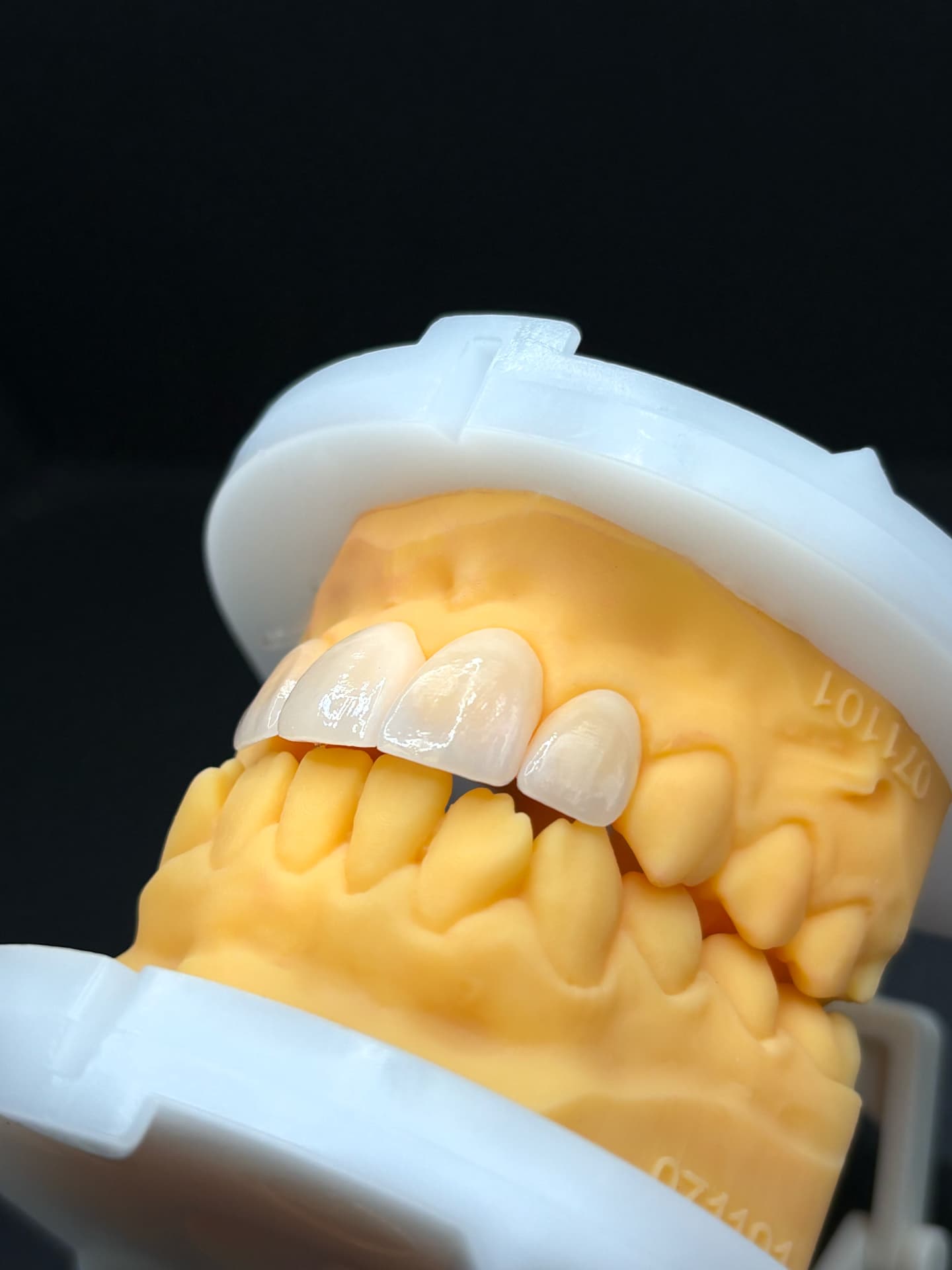 Esthetic veneers placed on an upper study model