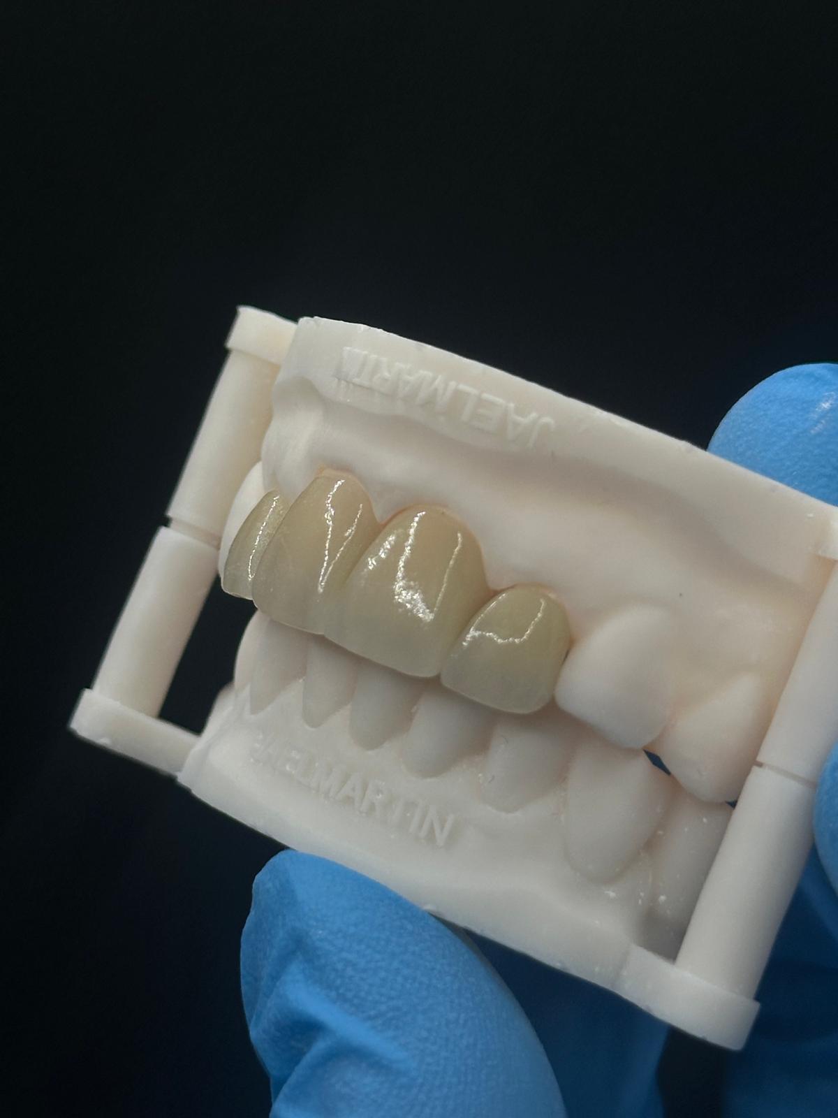 Close-up of layered anterior veneers on a model