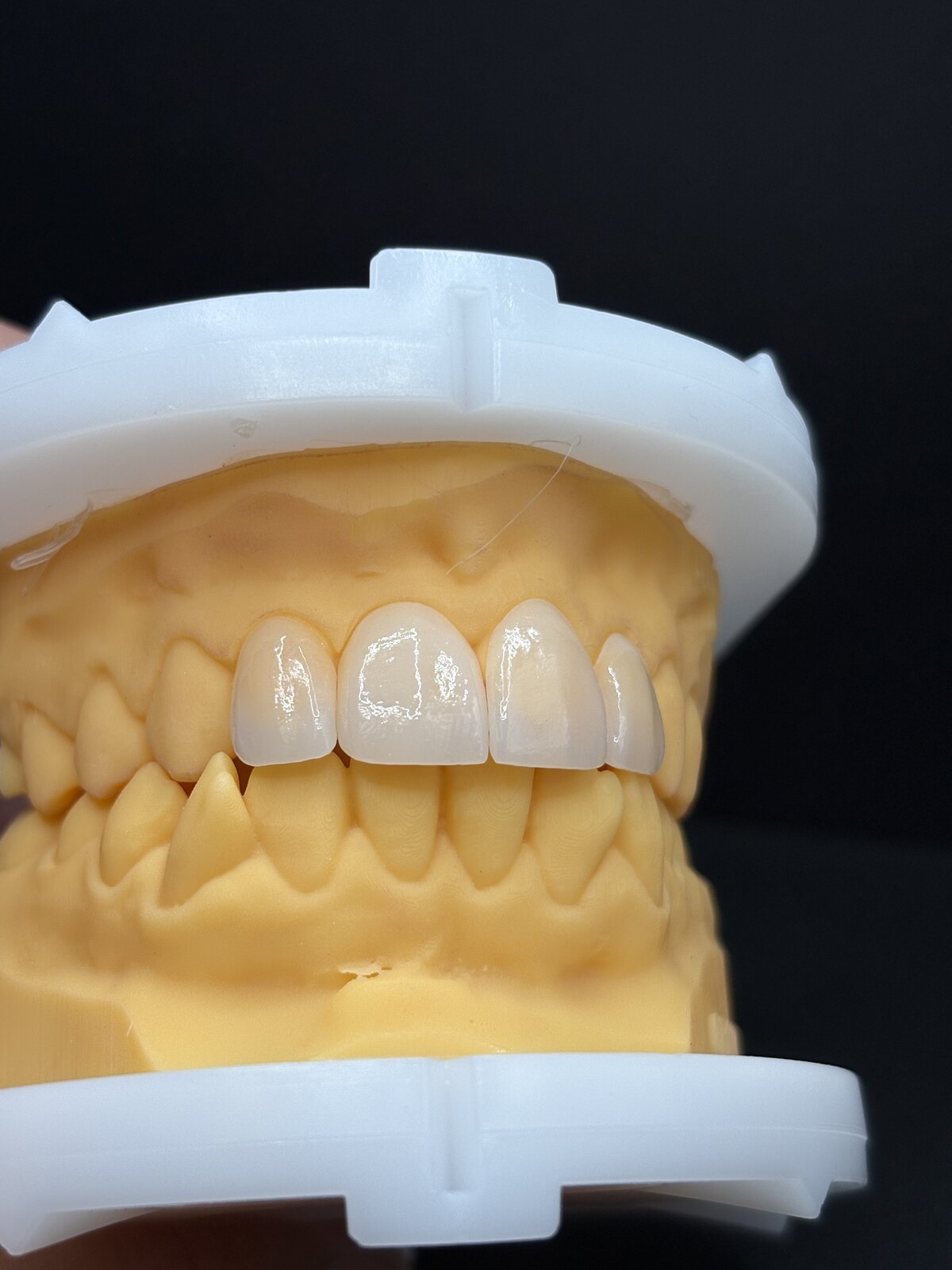 Anterior crowns finished on a dental model